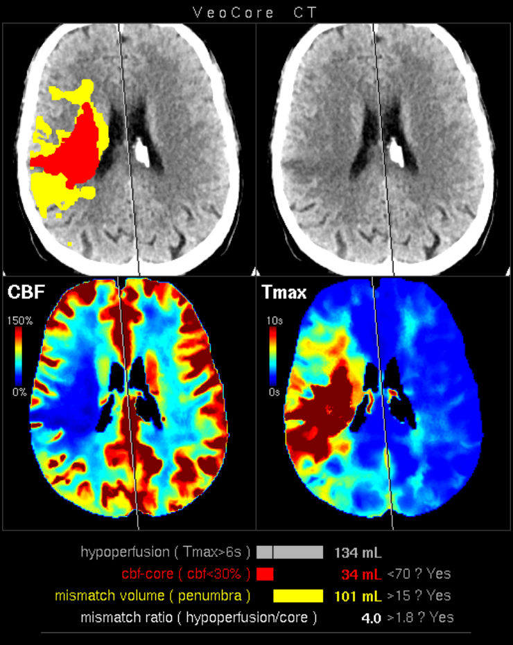 veocore lesionmap ct