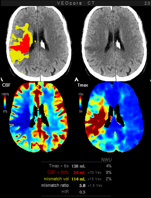 veocore lesionmap ct