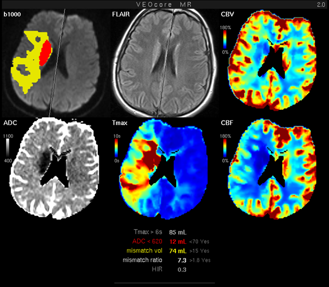 veocore lesionmap mr